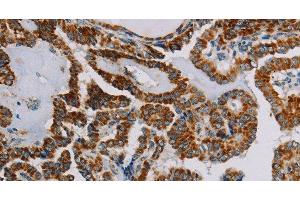 Immunohistochemistry of paraffin-embedded Human thyroid cancer using NDUFS3 Polyclonal Antibody at dilution of 1:30 (NDUFS3 anticorps)