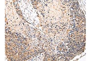 The image on the left is immunohistochemistry of paraffin-embedded Human esophagus cancer tissue using ABIN7131583(VPS37A Antibody) at dilution 1/20, on the right is treated with fusion protein.