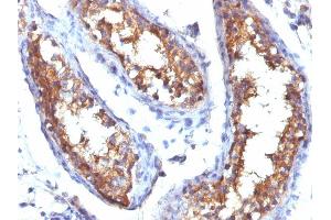 Formalin-fixed, paraffin-embedded human Testicular Carcinoma stained with CD99 Mouse Monoclonal Antibody (HO36-1. (CD99 anticorps)