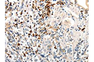 The image on the left is immunohistochemistry of paraffin-embedded Human gastric cancer tissue using ABIN7190149(CD93 Antibody) at dilution 1/60, on the right is treated with synthetic peptide. (CD93 anticorps)