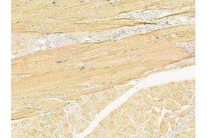 ABIN6260856 and ABIN6273101 at 1/100 staining human tongue carcinoma by IHC-P.