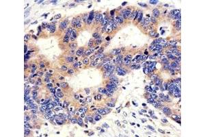 IHC analysis of FFPE human colon carcinoma section using anti-PCSK9 antibody