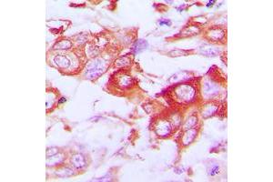 Immunohistochemical analysis of Claudin 7 staining in human lung cancer formalin fixed paraffin embedded tissue section.