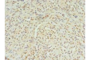 Immunohistochemistry of paraffin-embedded human breast cancer using ABIN7169003 at dilution of 1:100 (STK38L anticorps  (AA 212-464))