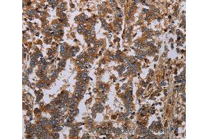 Immunohistochemistry of Human liver cancer using GDF2 Polyclonal Antibody at dilution of 1:40 (GDF2 anticorps)