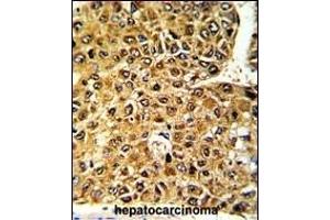 Formalin-fixed and paraffin-embedded human hepatocarcinoma with MLX Antibody (Center), which was peroxidase-conjugated to the secondary antibody, followed by DAB staining.