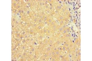 Immunohistochemistry of paraffin-embedded human liver cancer using ABIN7144419 at dilution of 1:100