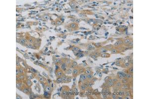 Immunohistochemistry of Human breast cancer using MAP2K6 Polyclonal Antibody at dilution of 1:30 (MAP2K6 anticorps)
