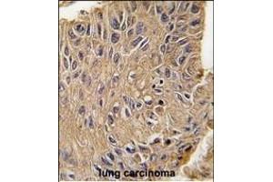 Formalin-fixed and paraffin-embedded human lung carcinoma tissue reacted with ANTXR1 Antibody  (ABIN392154 and ABIN2841879) , which was peroxidase-conjugated to the secondary antibody, followed by DAB staining. (ANTXR1 anticorps  (AA 358-386))