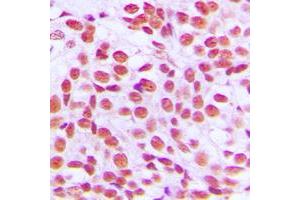 Immunohistochemical analysis of EGR1 staining in human breast cancer formalin fixed paraffin embedded tissue section. (EGR1 + EGR2 (C-Term) anticorps)