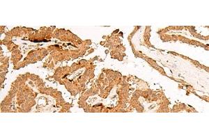 Immunohistochemistry of paraffin-embedded Human thyroid cancer tissue using POLR2L Polyclonal Antibody at dilution of 1:45(x200) (POLR2L anticorps)