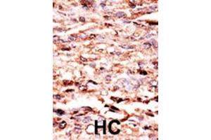 Formalin-fixed and paraffin-embedded human cancer tissue reacted with the primary antibody, which was peroxidase-conjugated to the secondary antibody, followed by AEC staining.