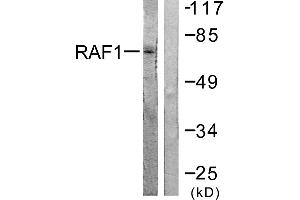 Immunohistochemistry analysis of paraffin-embedded human lung carcinoma tissue using Raf1 (Ab-621) antibody. (RAF1 anticorps  (Ser621))