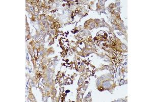 Immunohistochemistry of paraffin-embedded human lung cancer using CD52 antibody (ABIN7266207) at dilution of 1:100 (40x lens). (CD52 anticorps  (AA 1-61))