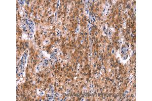 Immunohistochemistry of Human gastric cancer using GH1 Polyclonal Antibody at dilution of 1:40 (Growth Hormone 1 anticorps)