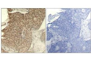 Immunohistochemical analysis of paraffin-embedded human breast carcinoma tissue using HDAC2(Phospho-Ser394) Antibody(left) or the same antibody preincubated with blocking peptide(right). (HDAC2 anticorps  (pSer394))