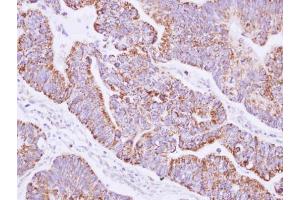 IHC-P Image Immunohistochemical analysis of paraffin-embedded human gastric cancer, using JIK, antibody at 1:100 dilution. (TAO Kinase 3 anticorps)
