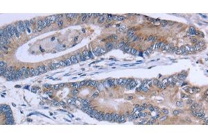 Immunohistochemistry of paraffin-embedded Human colon cancer using SLC1A6 Polyclonal Antibody at dilution of 1:40 (SLC1A6 anticorps)