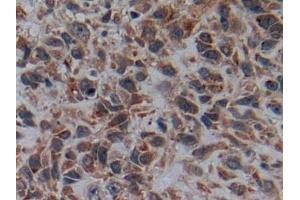 Detection of C2CD3 in Human Lung cancer Tissue using Polyclonal Antibody to C2 Calcium Dependent Domain Containing Protein 3 (C2CD3) (C2CD3 anticorps  (AA 1432-1647))