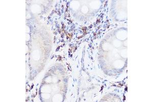 Immunohistochemistry of paraffin-embedded human colon carcinoma using Thromboxane synthase Rabbit pAb (ABIN6132172, ABIN6148915, ABIN6148917 and ABIN6219149) at dilution of 1:50 (40x lens).