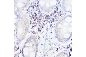Immunohistochemistry of paraffin-embedded human colon carcinoma using Thromboxane synthase Rabbit pAb (ABIN6132172, ABIN6148915, ABIN6148917 and ABIN6219149) at dilution of 1:50 (40x lens).
