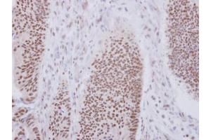 IHC-P Image Immunohistochemical analysis of paraffin-embedded human colon carcinoma, using XAB2, antibody at 1:250 dilution. (XAB2 anticorps  (N-Term))