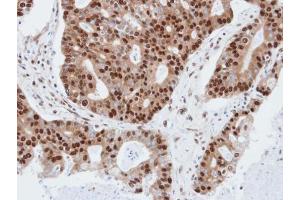 IHC-P Image Immunohistochemical analysis of paraffin-embedded human endo mitral, using PDE4C, antibody at 1:100 dilution. (PDE4C anticorps)