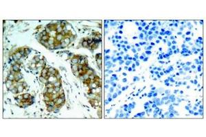 Immunohistochemical analysis of paraffin-embedded human breast carcinoma tissue using cdc25A(Phospho-Ser76) Antibody(left) or the same antibody preincubated with blocking peptide(right).
