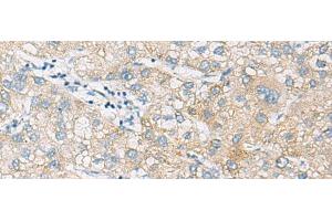 Immunohistochemistry of paraffin-embedded Human liver cancer tissue using NCOA4 Polyclonal Antibody at dilution of 1:130(x200) (NCOA4 anticorps)