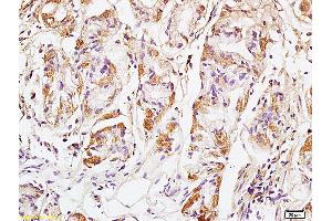 Formalin-fixed and paraffin embedded human colon carcinoma labeled with Anti GM130 Polyclonal Antibody, Unconjugated (ABIN872349) at 1:200 followed by conjugation to the secondary antibody and DAB staining (Golgin A2 (GOLGA2) (AA 851-1002) anticorps)