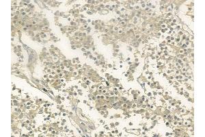 ABIN6260530 and ABIN6273206 at 1/100 staining human pituitary adenoma by IHC-P. (CCDC93 anticorps  (C-Term))