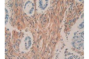 IHC-P analysis of Human Rectum Cancer Tissue, with DAB staining. (CD90 anticorps  (AA 20-133))
