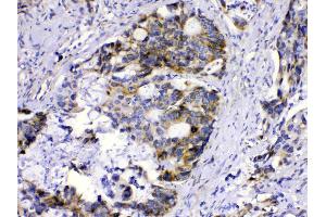 MUT was detected in paraffin-embedded sections of human intetsinal cancer tissues using rabbit anti- MUT Antigen Affinity purified polyclonal antibody (Catalog # ) at 1 µg/mL.