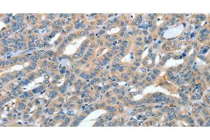 Immunohistochemistry of paraffin-embedded Human thyroid cancer tissue using ANGPT1 Polyclonal Antibody at dilution 1:50