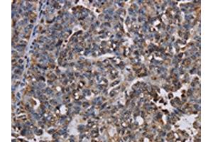 The image on the left is immunohistochemistry of paraffin-embedded Human ovarian cancer tissue using ABIN7130066(LBR Antibody) at dilution 1/50, on the right is treated with fusion protein. (Lamin B Receptor anticorps)