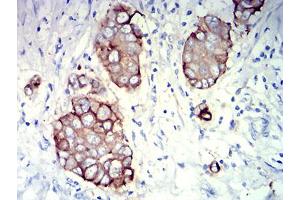 Immunohistochemical analysis of paraffin-embedded breast cancer tissues using CD227 mouse mAb with DAB staining.