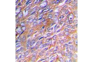 Immunohistochemical analysis of Collagen 3 alpha 1 staining in human breast cancer formalin fixed paraffin embedded tissue section.
