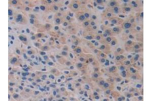 Detection of GHRH in Human Liver cancer Tissue using Monoclonal Antibody to Growth Hormone Releasing Hormone (GHRH)