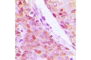 Immunohistochemical analysis of RPL5 staining in human breast cancer formalin fixed paraffin embedded tissue section. (RPL5 anticorps)