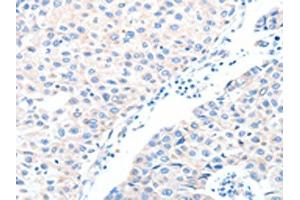 The image on the left is immunohistochemistry of paraffin-embedded Human breast cancer tissue using ABIN7128234(ADAM32 Antibody) at dilution 1/15, on the right is treated with fusion protein. (ADAM32 anticorps)