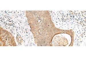 Immunohistochemistry of paraffin-embedded Human esophagus cancer tissue using TOR1A Polyclonal Antibody at dilution of 1:35(x200) (TOR1A anticorps)