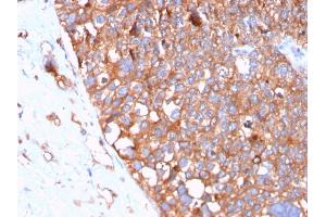 Formalin-fixed, paraffin-embedded human Urothelial Carcinoma stained with Uroplakin 1B Mouse Monoclonal Antibody (UPK1B/3102). (Uroplakin 1B anticorps  (AA 109-229))