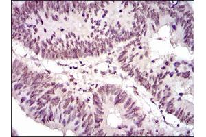 Immunohistochemical analysis of paraffin-embedded rectum cancer tissues using NCK1 mouse mAb with DAB staining. (NCK1 anticorps)