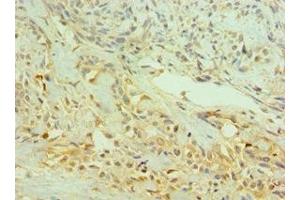 Immunohistochemistry of paraffin-embedded human breast cancer using ABIN7145333 at dilution of 1:100 (TRKB anticorps  (AA 32-282))