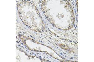 Immunohistochemistry of paraffin-embedded human prostate cancer using UBE2S antibody.