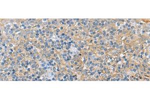 Immunohistochemistry of paraffin-embedded Human tonsil tissue using LRAT Polyclonal Antibody at dilution of 1:55(x200) (LRAT anticorps)
