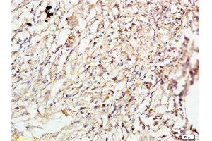 Formalin-fixed and paraffin embedded human lung carcinoma labeled with Anti-ROCK1 Polyclonal Antibody, Unconjugated  at 1:200 followed by conjugation to the secondary antibody and DAB staining. (ROCK1 anticorps  (AA 1001-1200))