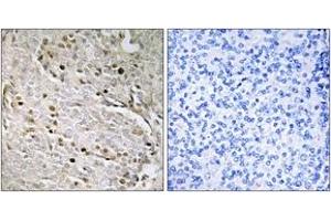 Immunohistochemistry analysis of paraffin-embedded human prostate carcinoma, using POTE8 Antibody. (POTEA anticorps  (AA 375-424))