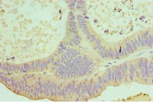 Immunohistochemistry of paraffin-embedded human colon cancer using ABIN7156853 at dilution of 1:100 (IL-22 anticorps  (AA 34-179))