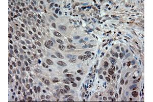 Immunohistochemical staining of paraffin-embedded Adenocarcinoma of colon using anti-NTF3 (ABIN2452683) mouse monoclonal antibody. (Neurotrophin 3 anticorps  (AA 139-257))